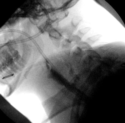 Esophagram shows a leak of contrast into the retropharyngeal soft tissues.