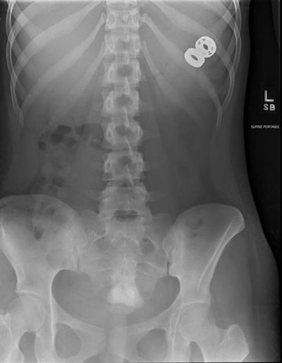 Abdomen radiograph shows the two pieces of spinner that were not surgically removed but which passed normally. Images courtesy of Dr. Jeffrey Otjen.