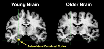 The figure shows two different brains aligned to a common template space for comparison. The yellow in the anterolateral entorhinal cortex of the young brain indicates significant activity, something that is absent in the older brain. Courtesy of Zachariah Reagh, PhD.