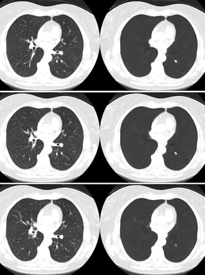 Images show three cropped, consecutive CT slices (left column) and their vessel-suppressed counterparts (right column). A 7-mm cancer on the left lung is obliquely overlapped by a vessel with superimposing signal intensity. Images courtesy of ShihChung Lo, PhD.