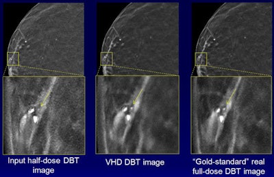 The images demonstrate how noise is reduced with the technique while the conspicuity of calcifications is maintained. Courtesy of Junchi Liu.