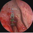 2018 03 14 17 47 1563 Ar Sinus Surgery 20180314171628