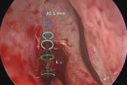 2018 03 14 17 47 1563 Ar Sinus Surgery 20180314171628