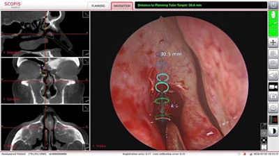 UTHealth sinus surgeons affiliated with Memorial Hermann-TMC have used augmented reality technology to perform minimally invasive sinus surgery. Image courtesy of Dr. Martin Citardi of UTHealth.