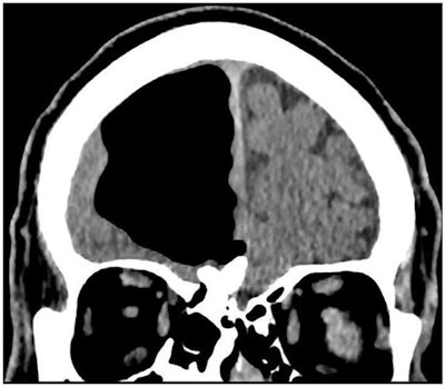 CT scan displays an air cavity in the right frontal lobe as well as an osteoma in the paranasal sinus. All images courtesy of BMJ Case Reports.