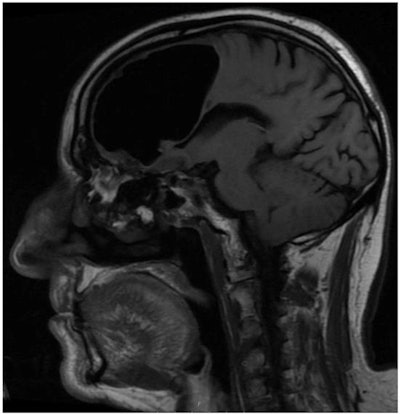 MR image shows the right frontal air-filled cavity.