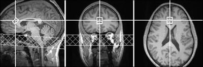 Researchers found an increase in the neurotransmitter glutamate in key regions of the brain in healthy subjects who received ADHD drugs. The increase was associated with positive emotion. Images courtesy of White Lab and Brown University.