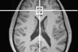 2018 03 15 16 40 4310 Mri Adhd Glutamane 200