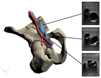 3D-reconstructed vascular model and corresponding ultrasound images of the common femoral (top), deep femoral (middle), and superficial femoral (bottom) arteries.