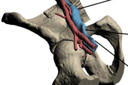 2018 03 19 22 11 1537 2018 03 20 3 D Printing Vascular Model2 20180319225418