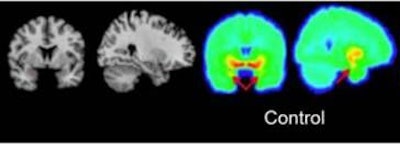 Voxel images of 5-HTT binding