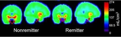 Averaged voxel images of control, remitter, and nonremitter 5-HTT binding at the plane of the amygdala. Images courtesy of Ananth et al and SNMMI.