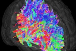 2018 04 09 20 50 5178 Cha Jama Brain Tracts 400