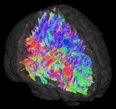 Images illustrate white-matter tracts estimated through DWI-MRI and tractography. Wiring patterns within the brain are thought to vary across individuals. The colors represent the directions of the white-matter tracts.
