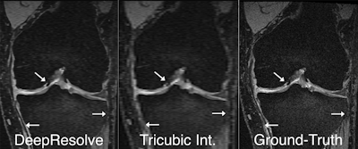 DeepResolve was found to enhance the image quality of blurry input images compared with other methods such as tricubic interpolation, which is commonly used in PACS and DICOM viewers. Example images demonstrate the inherent blurring present in coronal and axial reformations of sagittal acquisitions and how DeepResolve can eliminate much of the multiplanar reformation blurring. Images courtesy of Akshay Chaudhari, PhD.