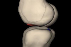 2018 04 17 23 42 5261 Acl Tear 20180417235413