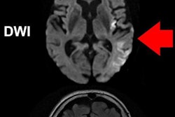 2018 04 24 21 44 2388 Mri Stroke 20180424214328