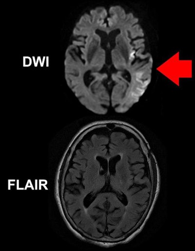 A DWI-MRI scan (top) of a brain shows brighter areas suggesting stroke damage (red arrow). A FLAIR scan (bottom) taken at the same time reveals no obvious acute ischemic damage. Image courtesy of Ona Wu, PhD.
