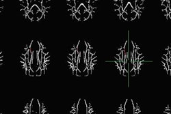 2018 04 24 22 49 3047 Arrs Dti Cocaine Axial Montage 20180424225527
