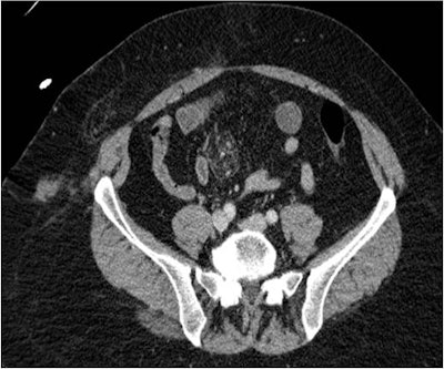 Above, 51-year-old woman with mesenteric contusion. Axial contrast-enhanced CT image of the abdomen shows ileal mesenteric contusion. Note soft-tissue contusion as well. Below, 68-year-old woman with posterior sternoclavicular joint dislocation. Sagittal CT of the chest at bone windows demonstrates posterior sternoclavicular dislocation, with the medial clavicle in close proximity to the great vessels but not in contact. Images courtesy of Anup Bhattacharya.