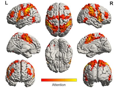 Functional MRI shows brain networks involved in processing attention that become active when listening to music. Image courtesy of University of Utah Health and the Brain Network Lab.
