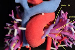2018 04 27 21 33 4984 3 D Printed Aorta 20180427215327