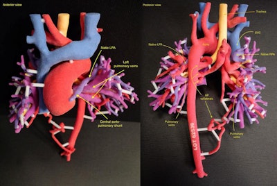 3D-printed pulmonary and aortic vasculature.