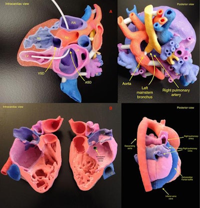 Multicolor 3D-printed heart. All images courtesy of Dr. Shafkat Anwar.