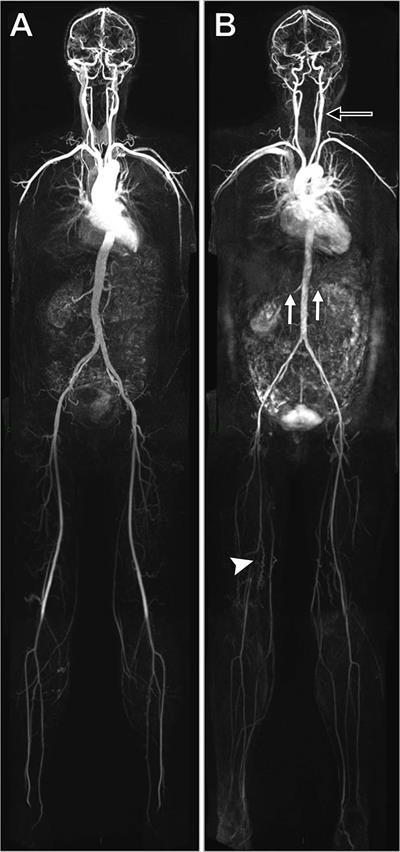 Whole-body MRA shows no evidence of disease in a 45-year-old woman (A). MRA in a 53-year-old woman (B) discovered extensive disease, including left carotid bulb stenosis (black arrow), bilateral renal artery stenosis (white arrows), and an occluded right superficial femoral artery (arrowhead). Image courtesy of RSNA and Radiology.