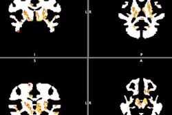 2018 05 01 23 19 1927 Myelin Tbi Image 20180501230542