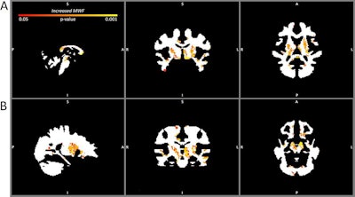 Myelin water fraction maps comparing the brains of contact sport players three months after mild TBI with the noncontact sport player baseline. A: Sagittal (left), coronal (center), and axial (right) maps at the level of the thalamus showing increased myelin water fraction (p < 0.05, familywise error corrected) in the anterior and posterior corpora callosa, thalamus, and midbrain. B: Sagittal (left), coronal (center), and axial (right) maps showing significant myelin water fraction increases (p < 0.05, familywise error corrected) in the midbrain and temporal lobes (left > right temporal lobe). Images courtesy of the American Association of Neurological Surgeons.