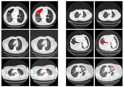 Six example heat maps generated from the patch-wise CNN output, along with input images. Source: Xiang Li, Subba Digumarthy, Mannudeep Kalra, Quanzheng Li, and James Thrall, in research protocol 'The application of deep-learning techniques in radiology.'