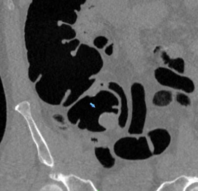 CT colonography reveals a large tubulovillous adenoma (2.3 cm) that was subsequently confirmed with colonoscopy. Image courtesy of Dr. Perry Pickhardt.