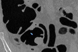 2018 05 07 19 41 7302 2018 05 08 Ctc Adenoma 20180507191113