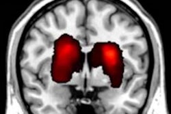 2018 05 08 22 13 0935 2018 05 09 Mri Stroke Attention Thumb