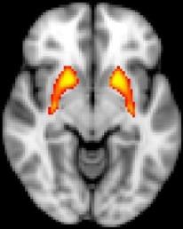 fMRI shows dysfunction in the striatum, which is associated with psychosis risk. Image credit: John Kerns.