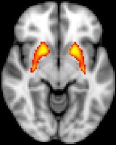 fMRI shows dysfunction in the striatum, which is associated with psychosis risk. Image credit: John Kerns.
