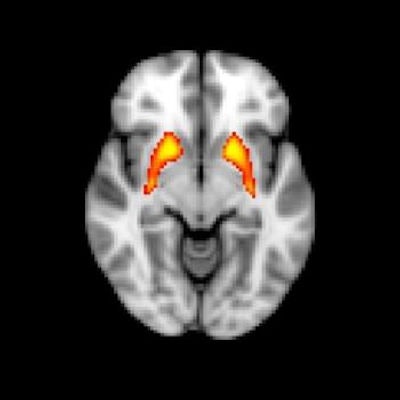 psychosis brain scan