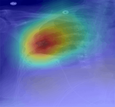 Heat maps represent areas of the radiograph that were activated by the deep-learning network and are used to determine the prediction class (large, moderate, or small pleural effusion). In addition to highlighting the meniscus of the effusion, the heat map also includes the lung parenchyma far above the meniscus. The network may be using the degree of aerated lungs to differentiate these classes of effusion, which in this case is a moderate effusion. Image courtesy of Dr. Rita Kanesa-thasan and Dr. Paras Lakhani.