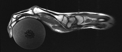 The glove design provides a T1-weighted MR image of a hand holding a peach.