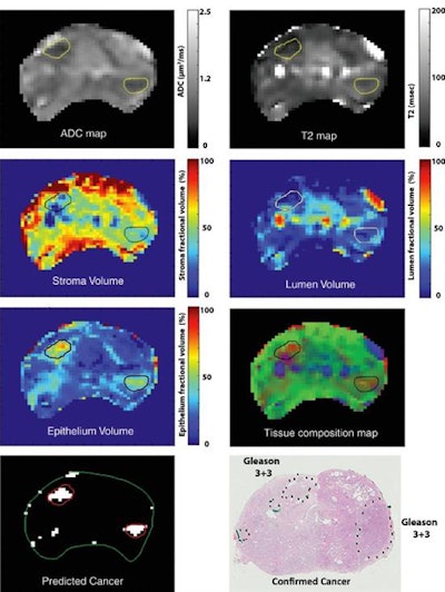 Tissue composition maps for the stroma, epithelium, and lumen estimated by using hybrid multidimensional MRI and corresponding T2, ADC, and histologic maps with cancer sites (Gleason score 3+3) marked. Composite map displays three tissue components in one image by using volume fractions of stroma (green), epithelium (red), and lumen (blue). Cancers appear red due to increased epithelium and loss of lumen and stromal volume. Cancer was predicted based on a fractional volume of epithelium higher than 40% and fractional volume of lumen less than 20%. Images courtesy of Radiology.