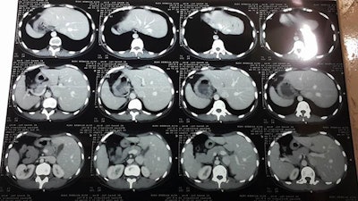 Printed CT images were accidentally placed in reverse on the viewbox and captured by a cellphone camera and sent to the TRG for interpretation.