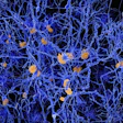 2017 04 14 16 09 55 745 Amyloid Plaque Alzheimer 400