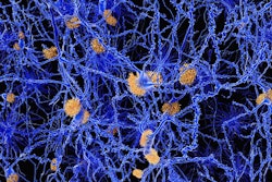 2017 04 14 16 09 55 745 Amyloid Plaque Alzheimer 400