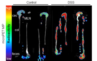 Immuno-PET scans of the colon (col), cecum (cec), and mesenteric lymph nodes (MLN) of mice with dextran sulfate sodium (DSS)-induced IBD and without (control). Image courtesy of Amanda Freise, PhD, and colleagues from UCLA.
