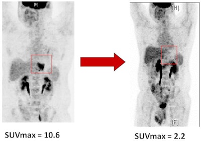PET scans before and after chemotherapy from a patient who responded to treatment. There is increased FDG uptake in the lower esophagus before chemotherapy (red box in left image) and minimal FDG uptake after chemotherapy (red box in right image).