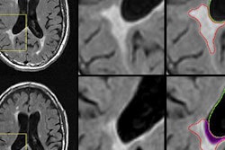 2018 06 05 22 38 2133 Atrophied Lesion 20180605223030