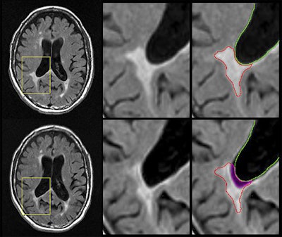 MR images represent an atrophied, or disintegrating, lesion on baseline (top row) and follow-up scans (bottom row). Part of the original lesion (bottom right, magenta region) has disintegrated into cerebrospinal fluid over the intervening period. Nearly 20% percent of the lesion was lost over time. Images courtesy of Michael Dwyer, PhD.