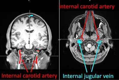 The technique is based on fMR images that are used to calculate the cerebral circulation time of young, healthy individuals. Image courtesy of Purdue University.