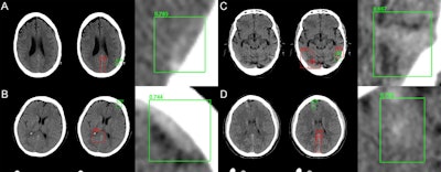Network predictions by the algorithm include bounding box region proposals for potential areas of abnormality (to focus algorithm attention) and final network predictions -- including confidence of the result. Correctly identified areas of hemorrhage (green) include subtle abnormalities representing subarachnoid (A), subdural (B and C), and intraparenchymal (D) hemorrhage. Correctly identified areas of excluded hemorrhage often include common mimics for blood on noncontrast CT including thickening/high density along the falx (A, B, and D) and beam hardening along the peripheral brain convexity (D).